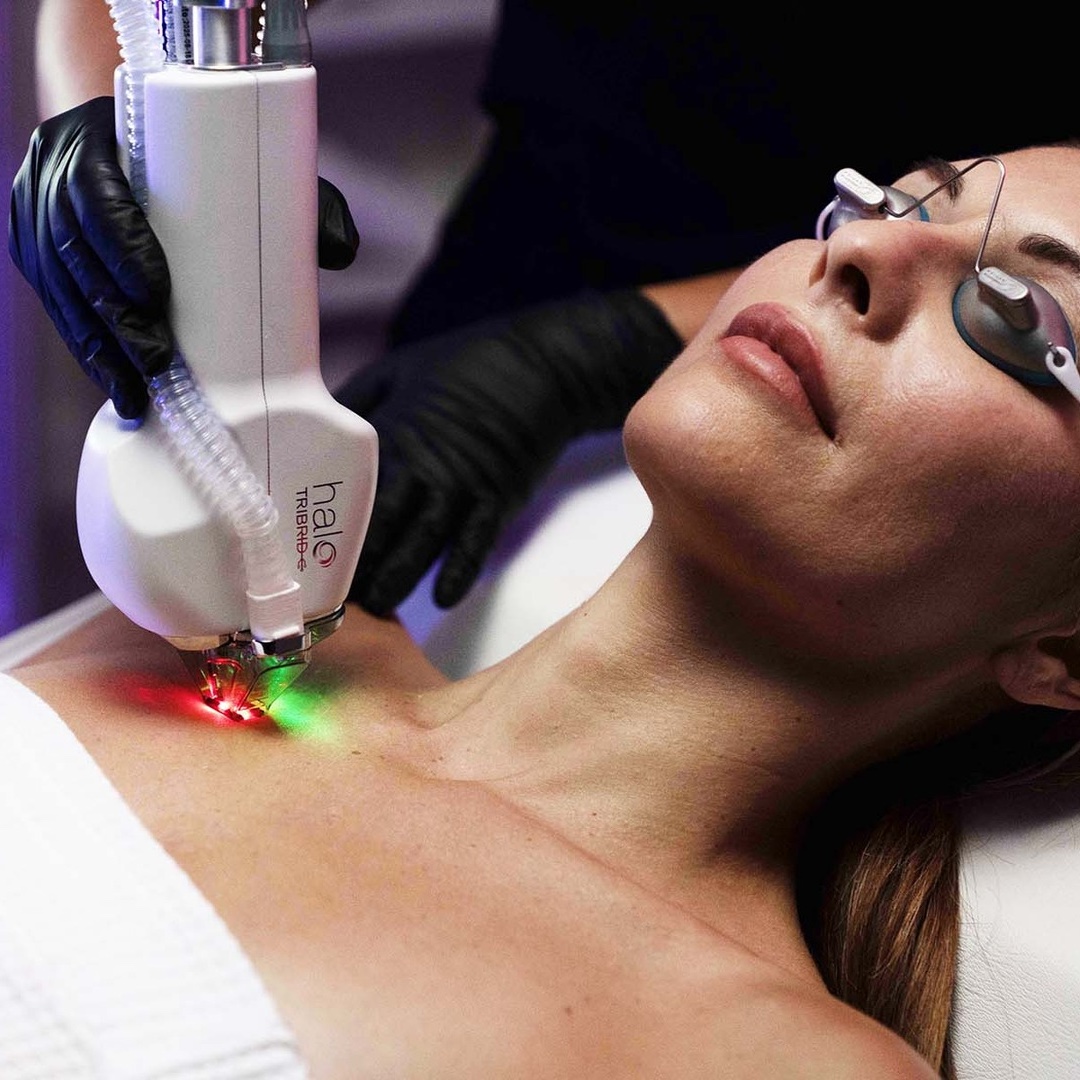 Photo of a woman getting a HALO TRIBRID laser treatment