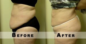 Before and After Laser Liposuction
