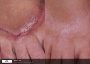 before and after scar treatments
