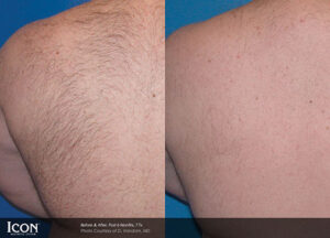 before and after hair removal photos