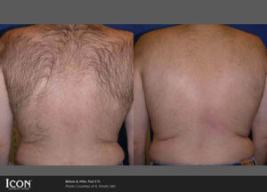 before and after back hair removal