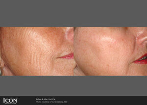 before and after Photorejuvenation treatments
