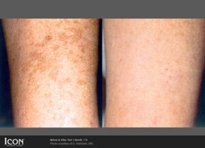Photorejuvenation treatments before and after for the arm