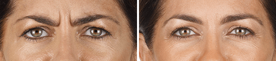 Xeomin Before and After results