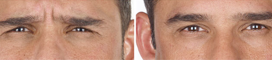 Xeomin Before and After results for Men