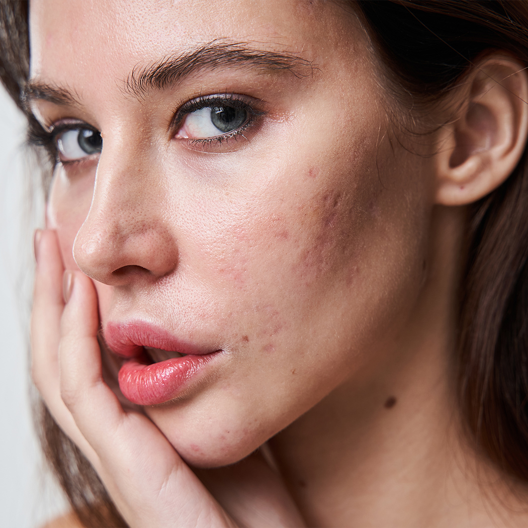 B-Acne-Scars-1.jpg