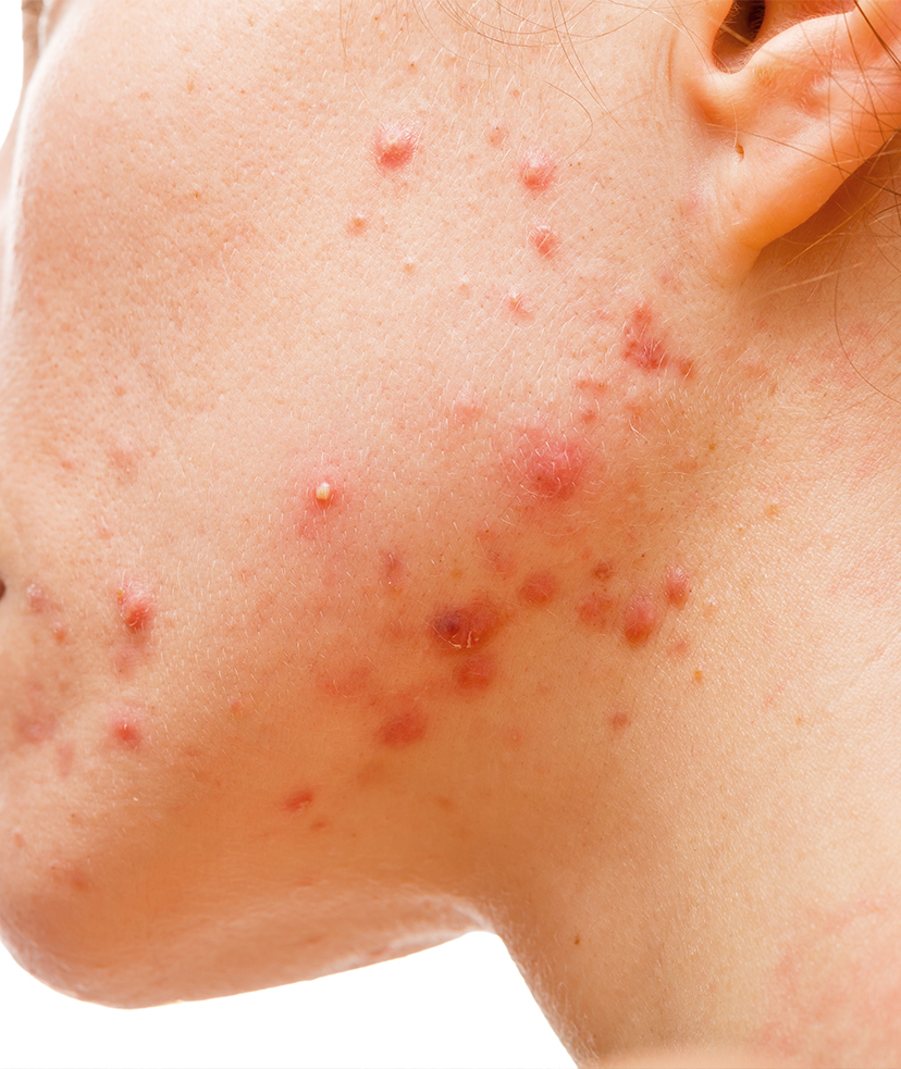Close-up photo of acne on a person's face
