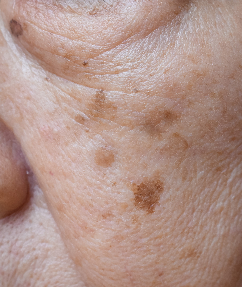Close-up photo of brown spots on a woman's face