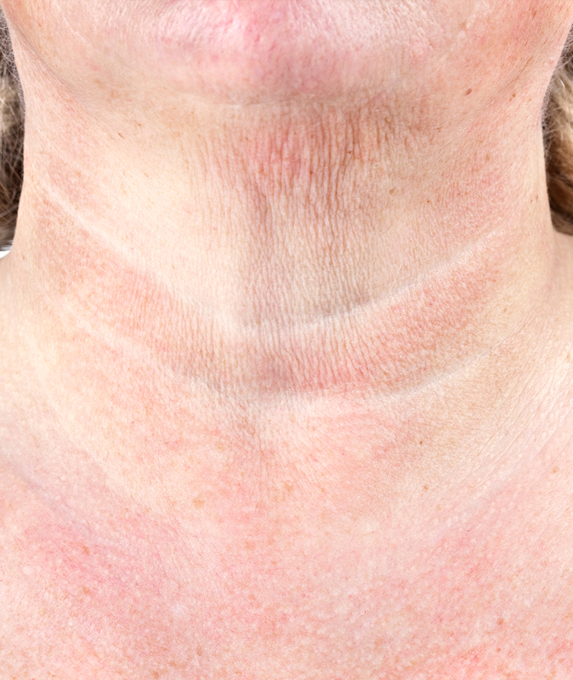 Photo of crepey skin on a woman's neck