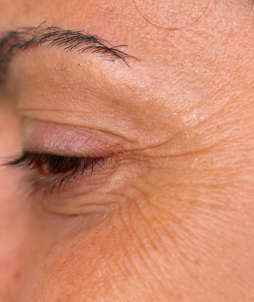 Close-up photo of crow's feet on a woman's face
