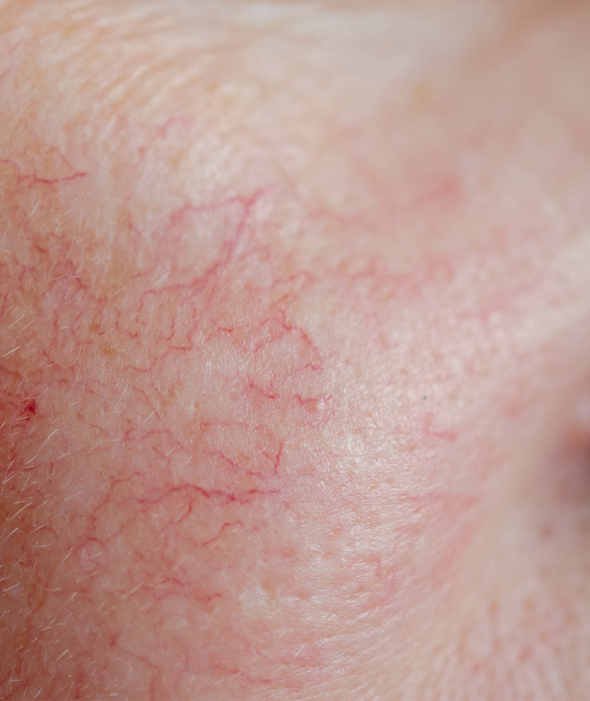 Close-up image of veins on a person's cheek