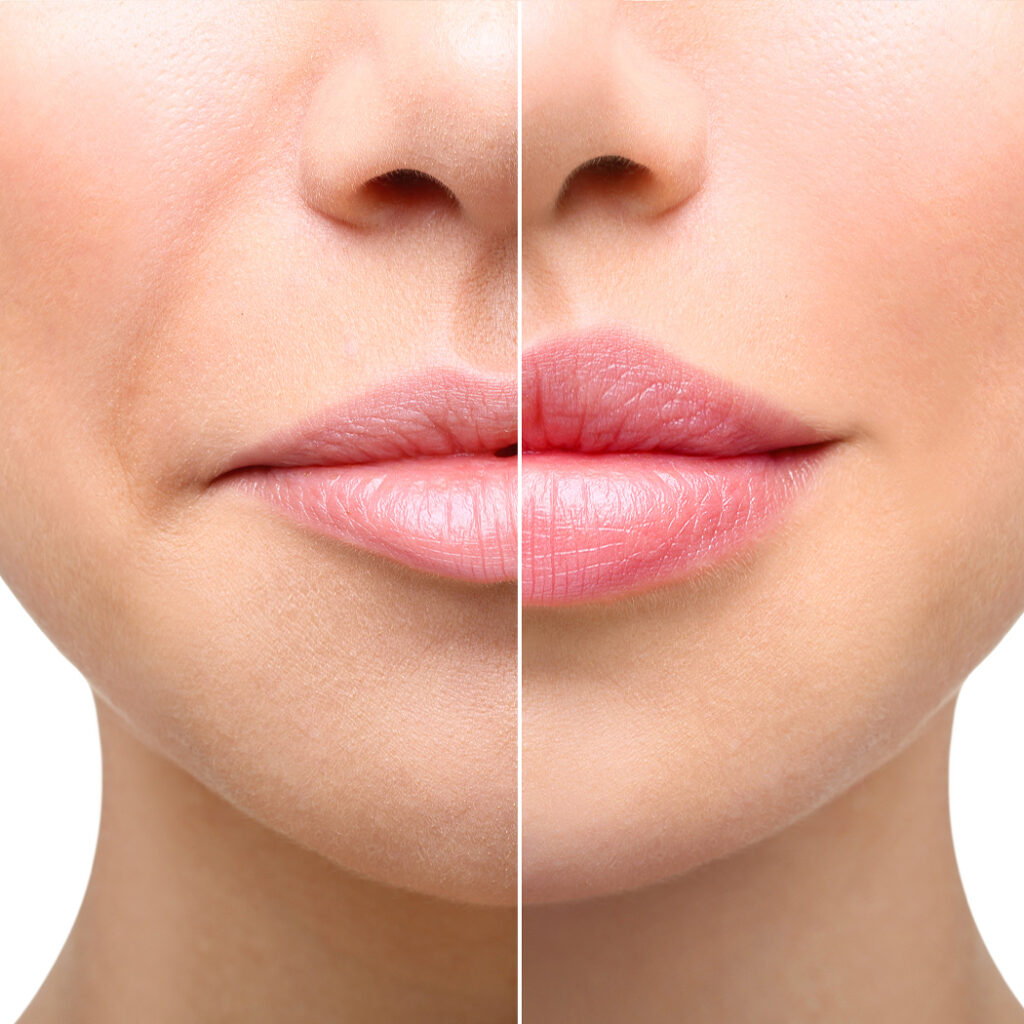 Side-by-side photos of a woman's face with and without prominent nasolabial fold lines