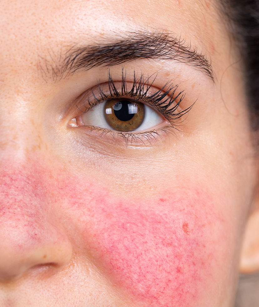 Close-up image of rosacea on a woman's cheek