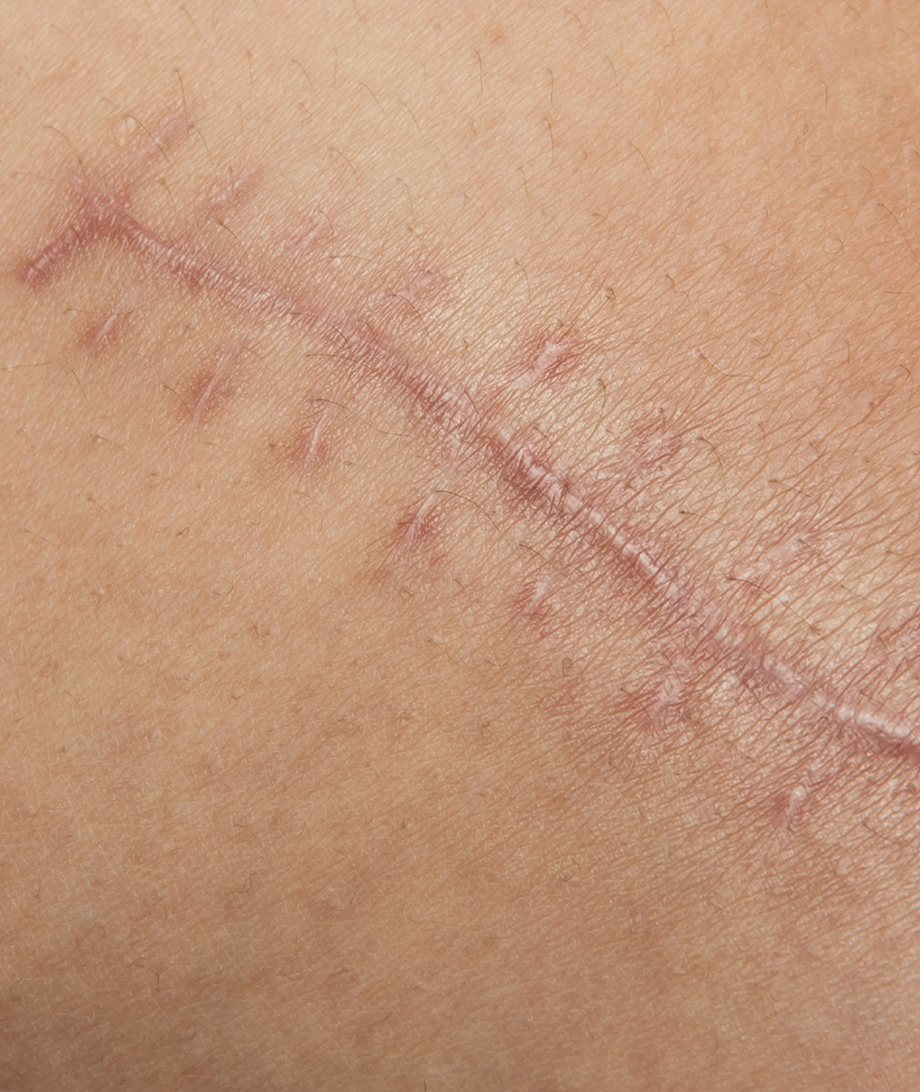 Close-up photo of a surgical scar