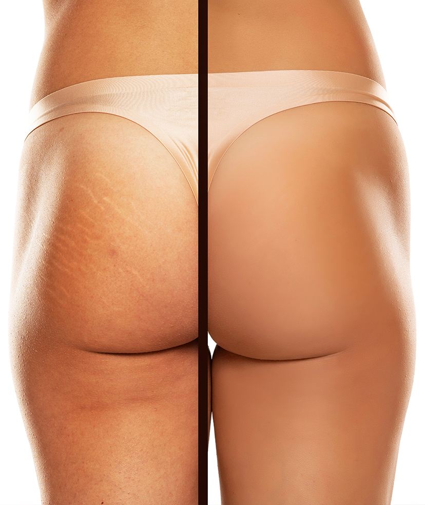 Before and after photos of stretch marks on a woman's buttock