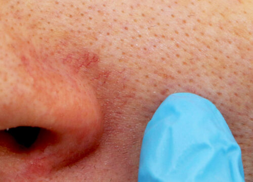 Photo of a facial veins around a person's nose
