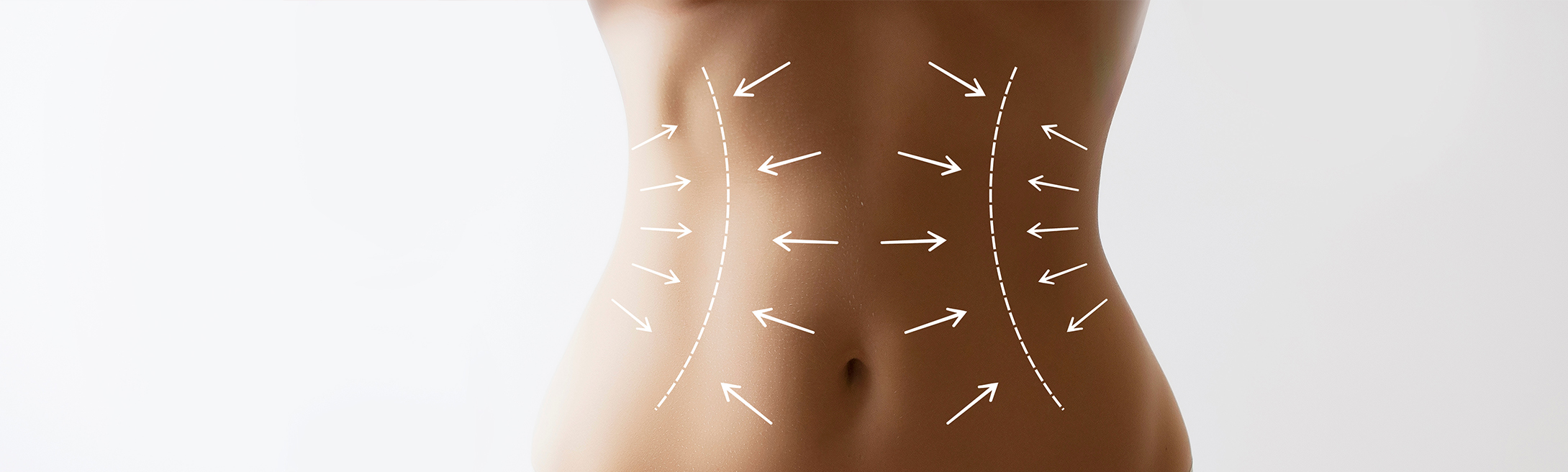 Laser Liposuction Wellesley, MA MD TLC™