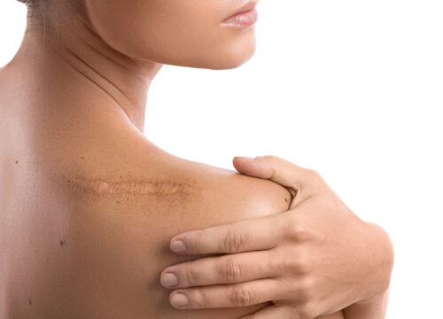Photo of a woman with a scar on her shoulder