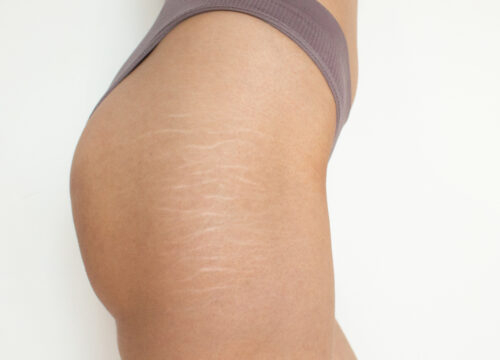 Photo of stretch marks on a woman's body