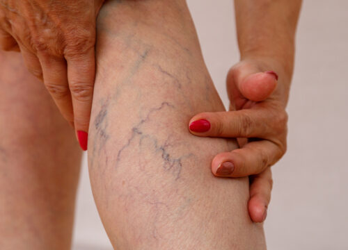 Photo of varicose veins on a woman's legs