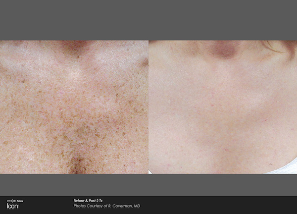 Before and after photorejuvenation results