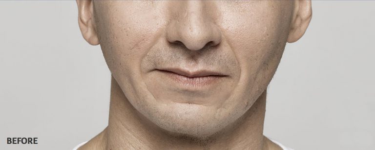 Before photo of a man before dermal filler treatments