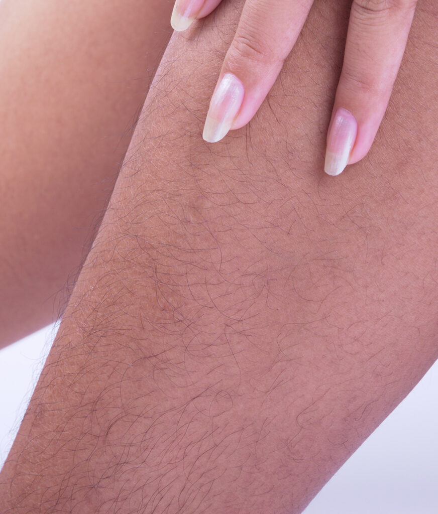 Photo of unwanted hair on a woman's leg