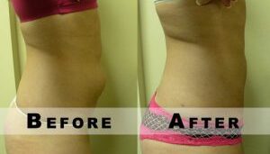 Before and after laser liposuction results