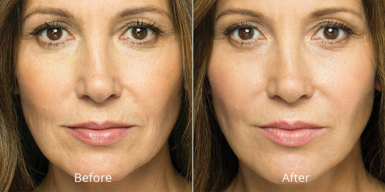 Before and after Belotero Balance® results