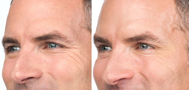 Before and after photos of Botox® results on a man