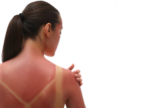 Photo of a woman with a sunburn on her back