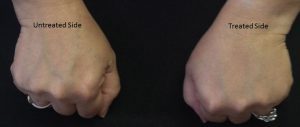Before and after photo of hand rejuvenation