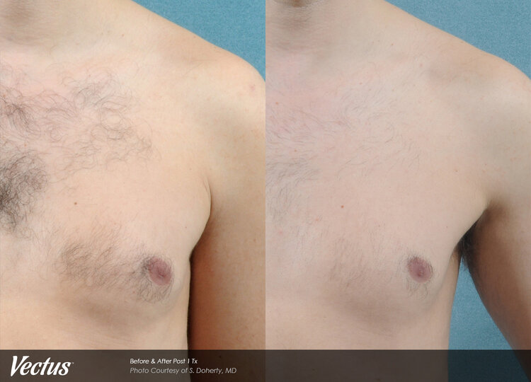 Before and after Vectus® laser hair reduction results