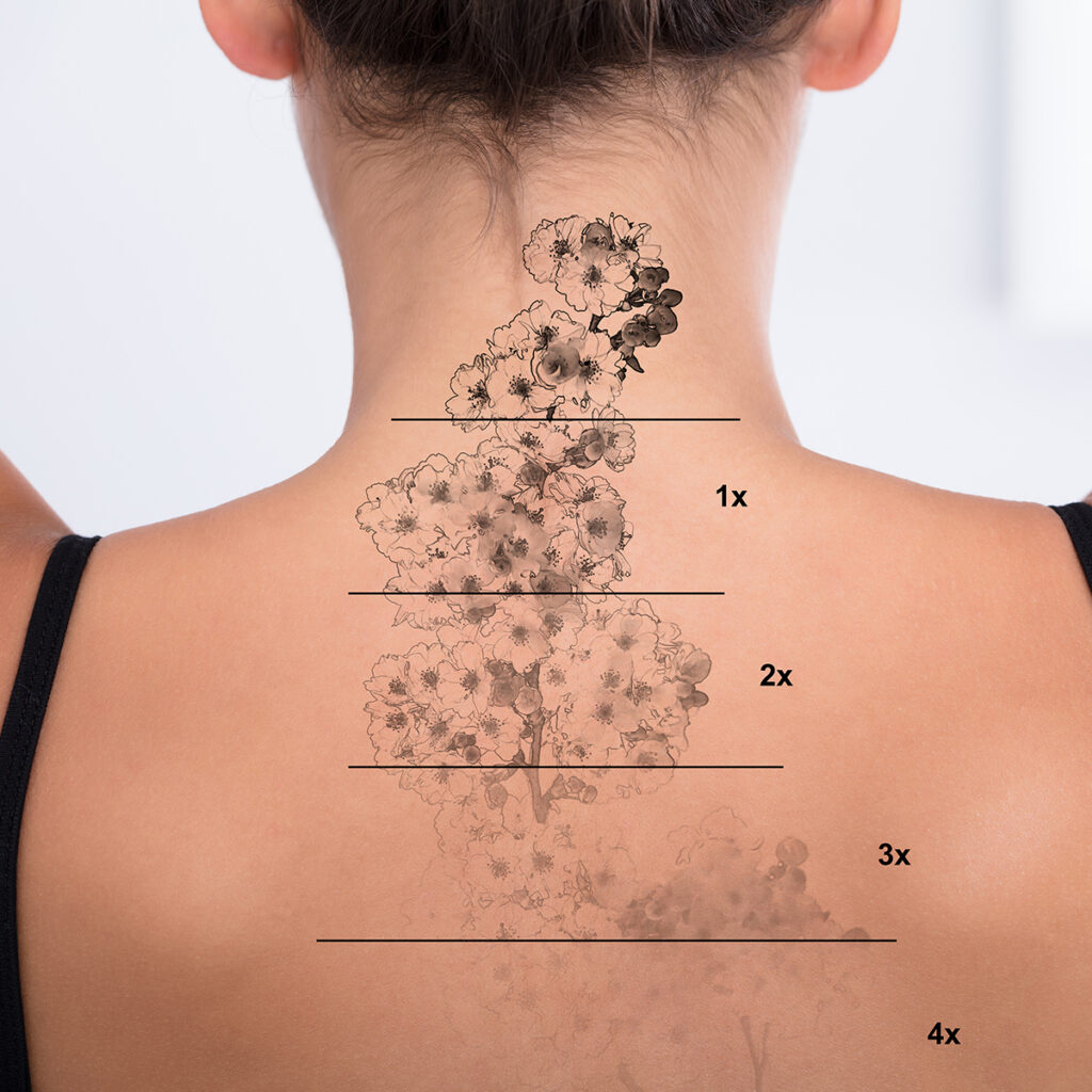 Photo of tattoo removal on a woman's back and neck